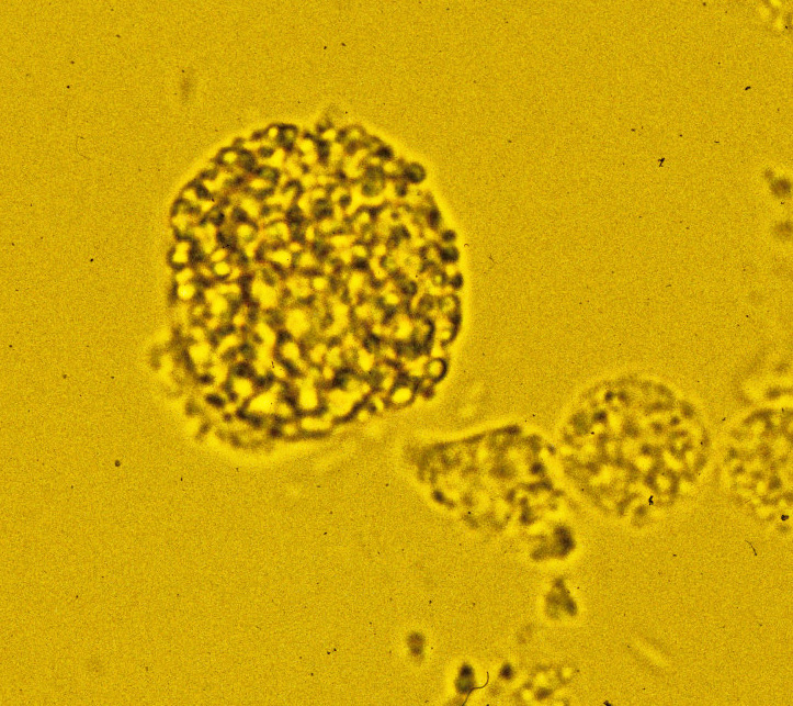 macrophage in urine sediment