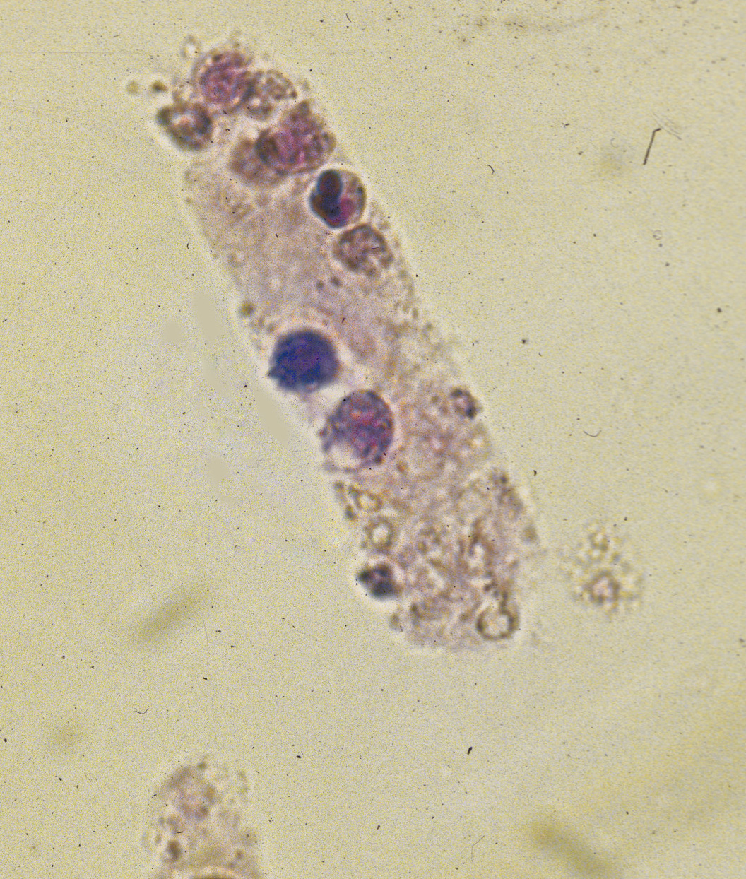 White Blood Cells Casts